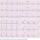 Archivos de cardiología de México - Tromboembolia pulmonar masiva