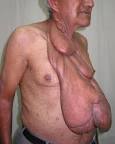 Neurofibromatosis