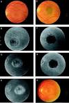 to occult <b>choroidal</b>