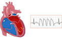 Ventricular <b>tachycardia</b> is a
