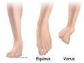 A Patient's Guide to Clubfoot