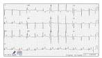 <b>Hipertrofia Ventriculo</b> Esquerdo | Atendimentos Particulares