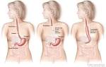 cancer of the esophagus.