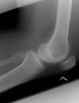 Benign Lytic Lesions and Bone Tumours