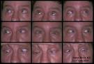 EyeRounds.org: Parinaud's Syndrome (Dorsal Midbrain Syndrome) with ...