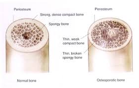 هشاشة العظام مرض صامت فاحذري منه Images?q=tbn:ANd9GcTx272be4fYJ-J1hL9-2mRsRhyGIMbD92zuWPhSB4IXilK9k1p-