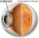 Cataracts | Eye Problems | Eye Diseases | Cataract Surgery
