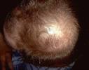 Androgenetic alopecia