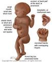 TRISOMY 18. Causes, symptoms, treatment TRISOMY 18