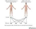 Autosomal dominant genes - Autosomal dominant Pictures &amp; Images ...