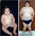 Prader Willi Syndrome | Syndrome Care