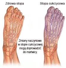 cukrzyca typu 2
