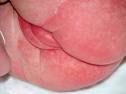 tilltagande <b>svullnad</b> och