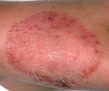 skin fungus