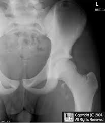 Avulsion Fracture of Lesser