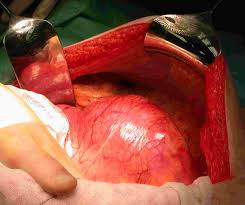 Left unchecked, AAAs can