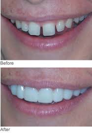 Snap on Smile Norman,