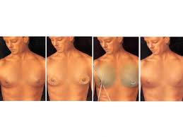 gynecomastia