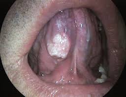 رجب محمد التدخين Tongue_cancer