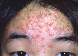 /]Pop That Zit.com[/url]