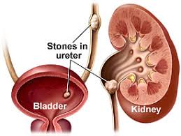 care for kidney stone