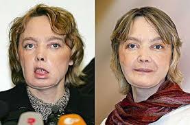 about face transplants.