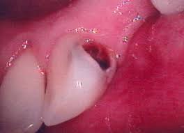 pictures cavity