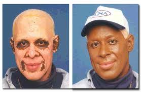 Vitiligo photos and related