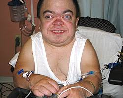 disease was called MPS VI,