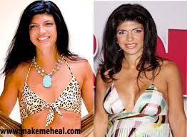 Teresa Giudice, Plastic
