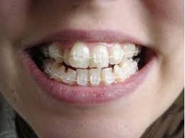 brackets Brackets   Aparato dental