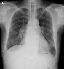 with pulmonary congestion