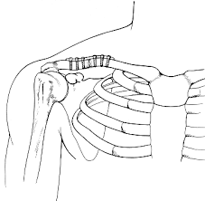 broken clavicle in place