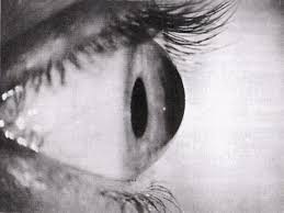 eye astigmatism 