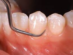 hygiene1 Porque visitar a tu dentista
