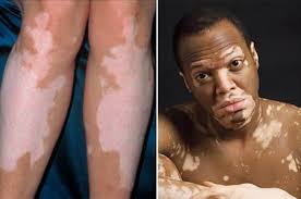 The cause of vitiligo is