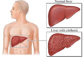 Infection with hepatitis B