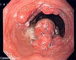 esophageal cancer