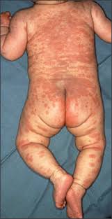 Infant with Kawasaki disease