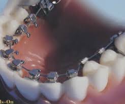 Lingual braces