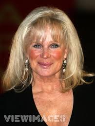 Linda Evans Cheek Implants and