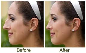 rhinoplasty