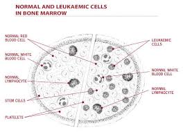 blood cancer