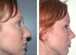 rhinoplasty