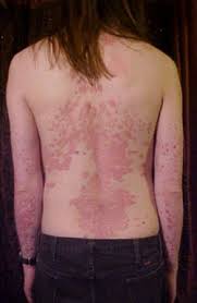 Psoriasis treatment - Skin
