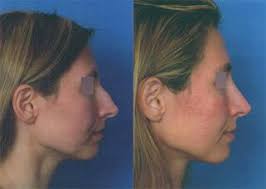 rhinoplasty