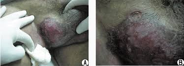 adenopatia inguinal