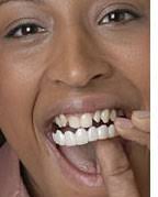 The Snap-On Smile snaps on to