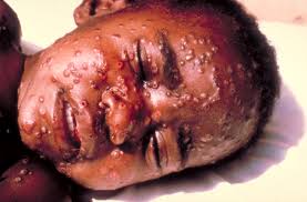File:Smallpox.jpg - Wikipedia,