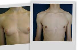 gynecomastia